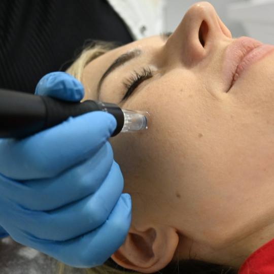 Angels #novisad Dermaroler i dermapen Dermapen Tretman Lica