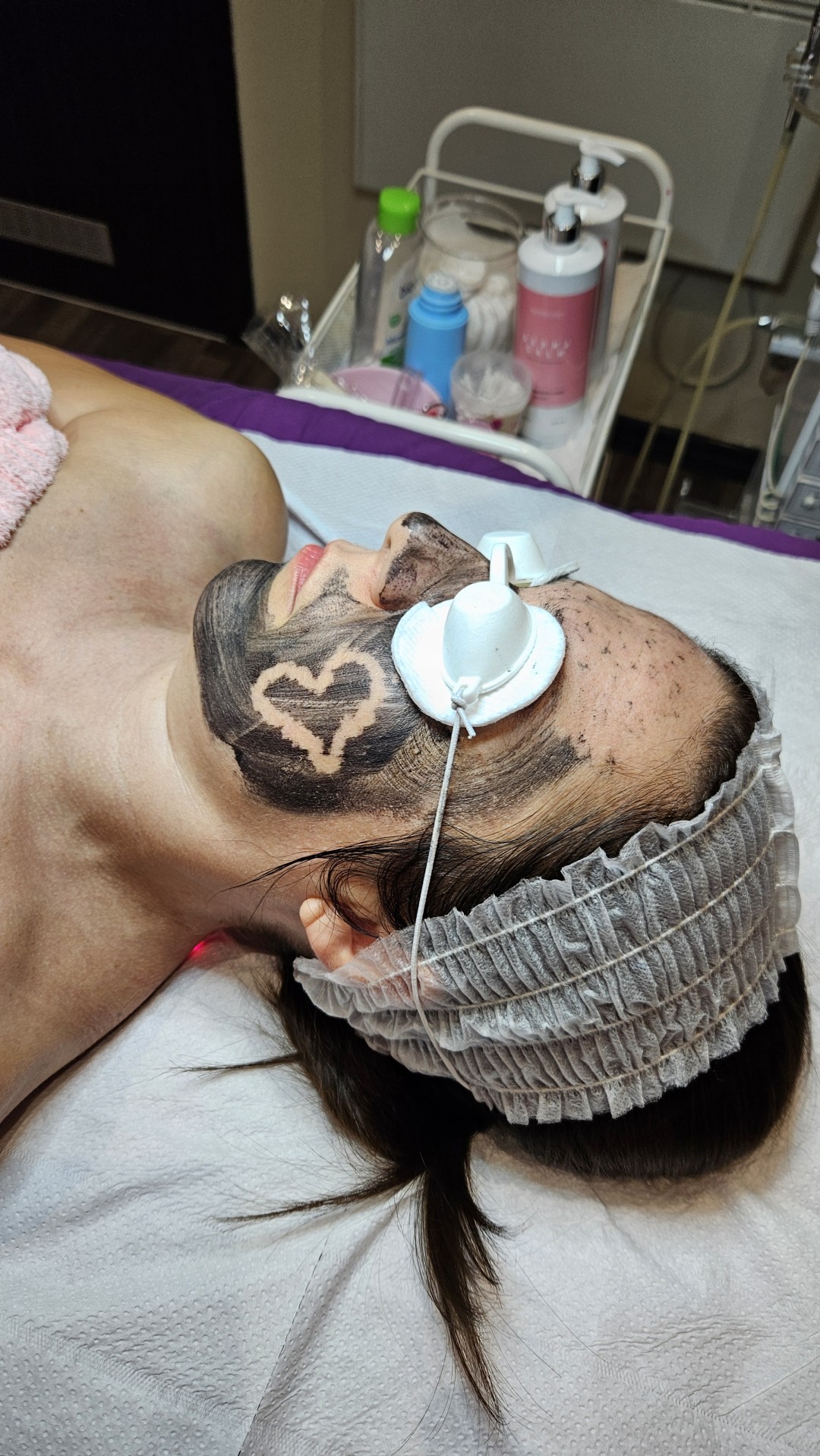 Starmedic #beograd Laserski tretmani lica Karbon laserski piling - tretman lica