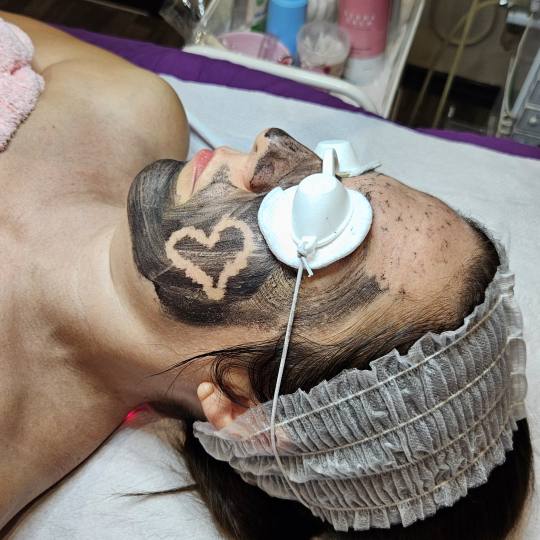 Starmedic #beograd Laserski tretmani lica Karbon laserski piling - tretman lica