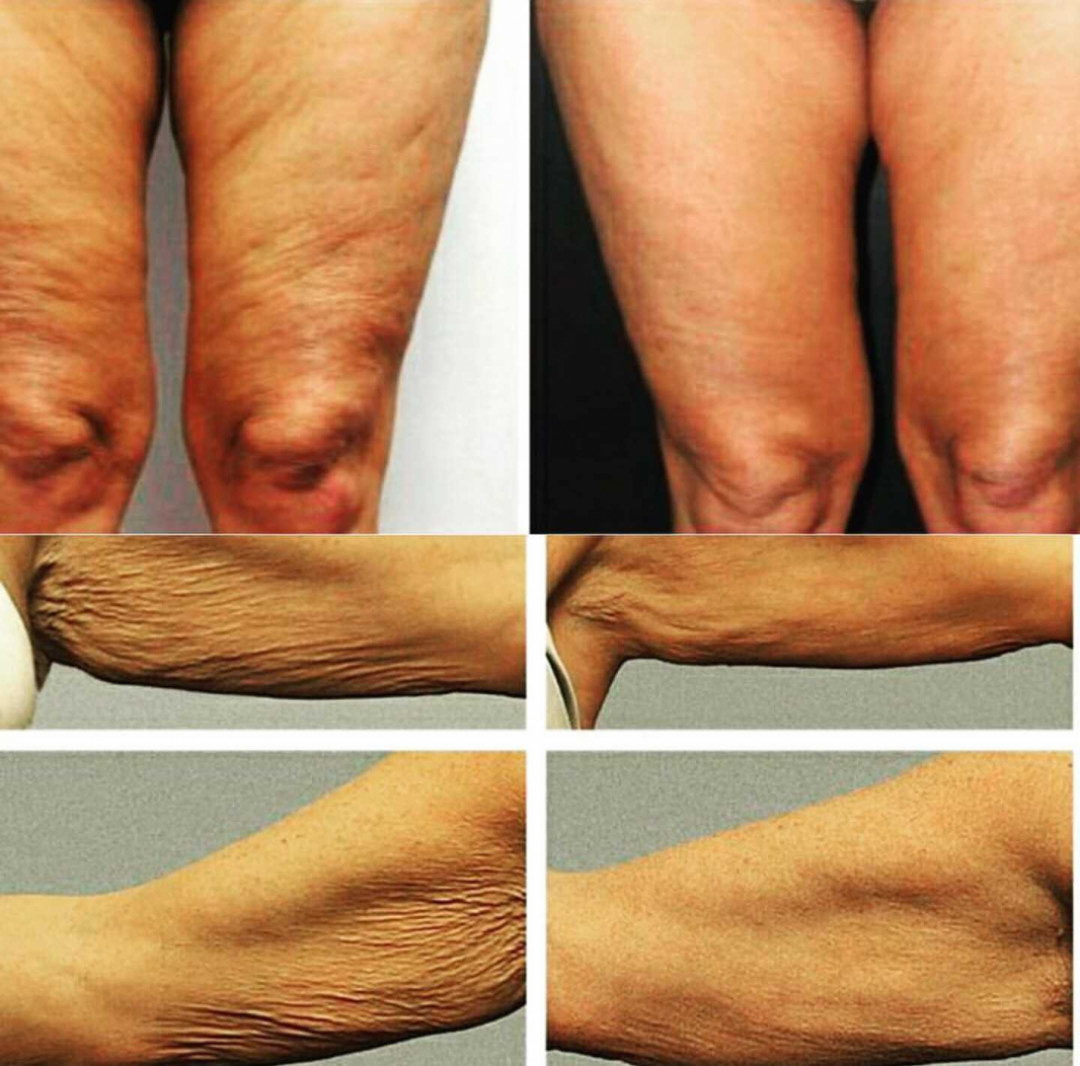 Grossi cosmetic #beograd Lifting / zatezanje kože