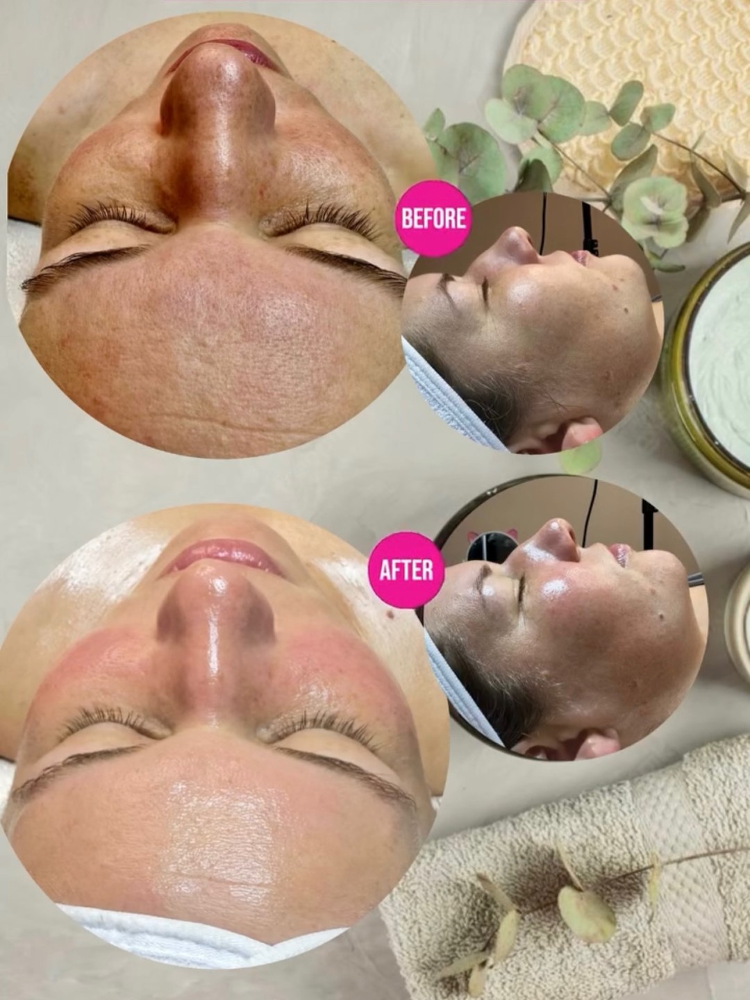 Deep Clean - higijenski tretman+ hydrafacial + UV špatula - Zen Club, Beograd Tretman lica Lice Tretman lica, Beograd, Vidikovac, Petlovo brdo, Labudovo brdo