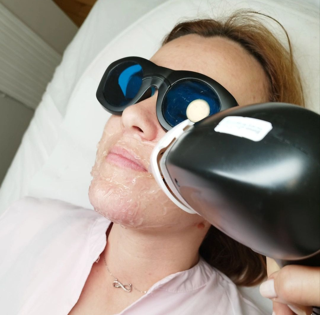 Kokilie Beauty Studio #novisad Laserska epilacija Laserska epilacija lica - za dame