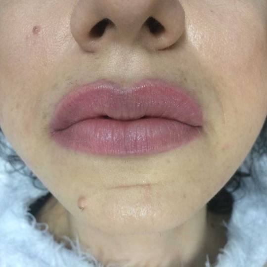 Sauriege #beograd Hijaluronski tretmani lica