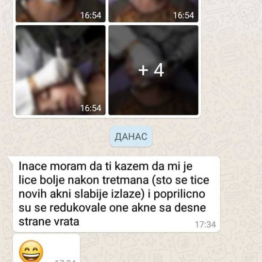AltaBella Batajnica #beograd Laserski tretmani lica Lasersko uklanjanje akni i ožiljaka