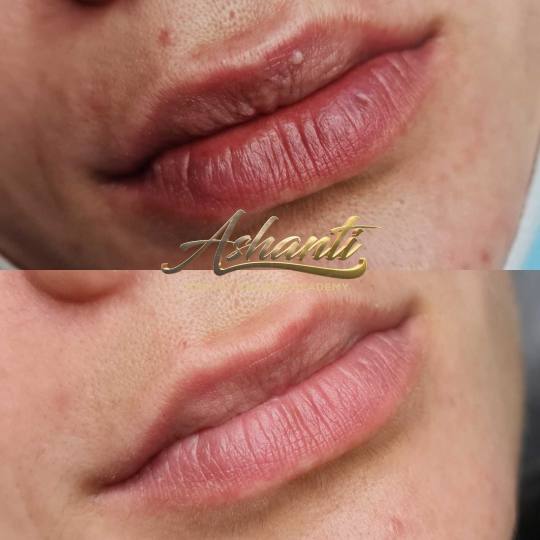 Ashanti Beauty Salon & Academy #beograd Tretman lica Plasma pen - skidanje 1 bradavice