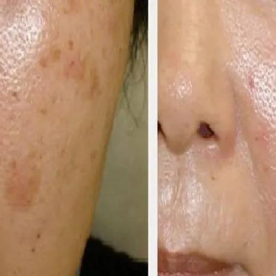 Astradas 2 #beograd Tretman lica Tretman lica voćnim kiselinama