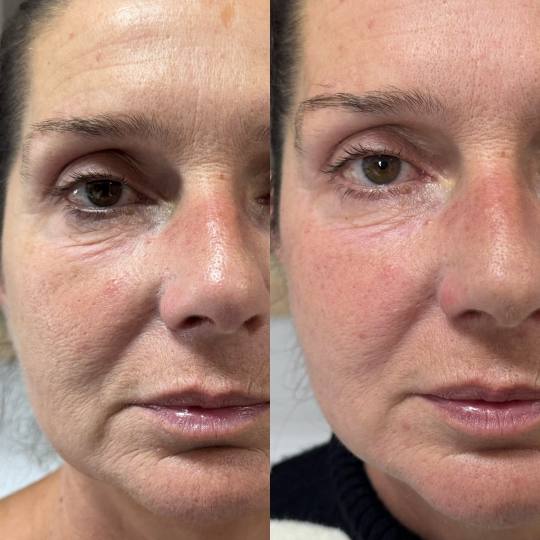 Estetski centar Đina #beograd Tretman lica Radiotalasni lifting lica Radio-talasni lifting (RF lift