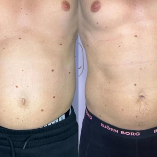 Attento Aesthetic #beograd Tretmani tela Personalizovani Attento tretmani tela - paket od 10 tretman