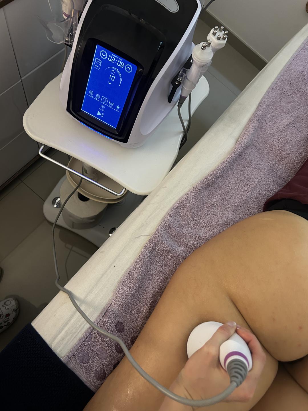 Kavitacija - 1 regija - Mila Beauty Centar, Beograd Tretmani tela Telo Tretmani tela, Beograd, Bežanijska kosa, Bežanija, Ledine, Surčin