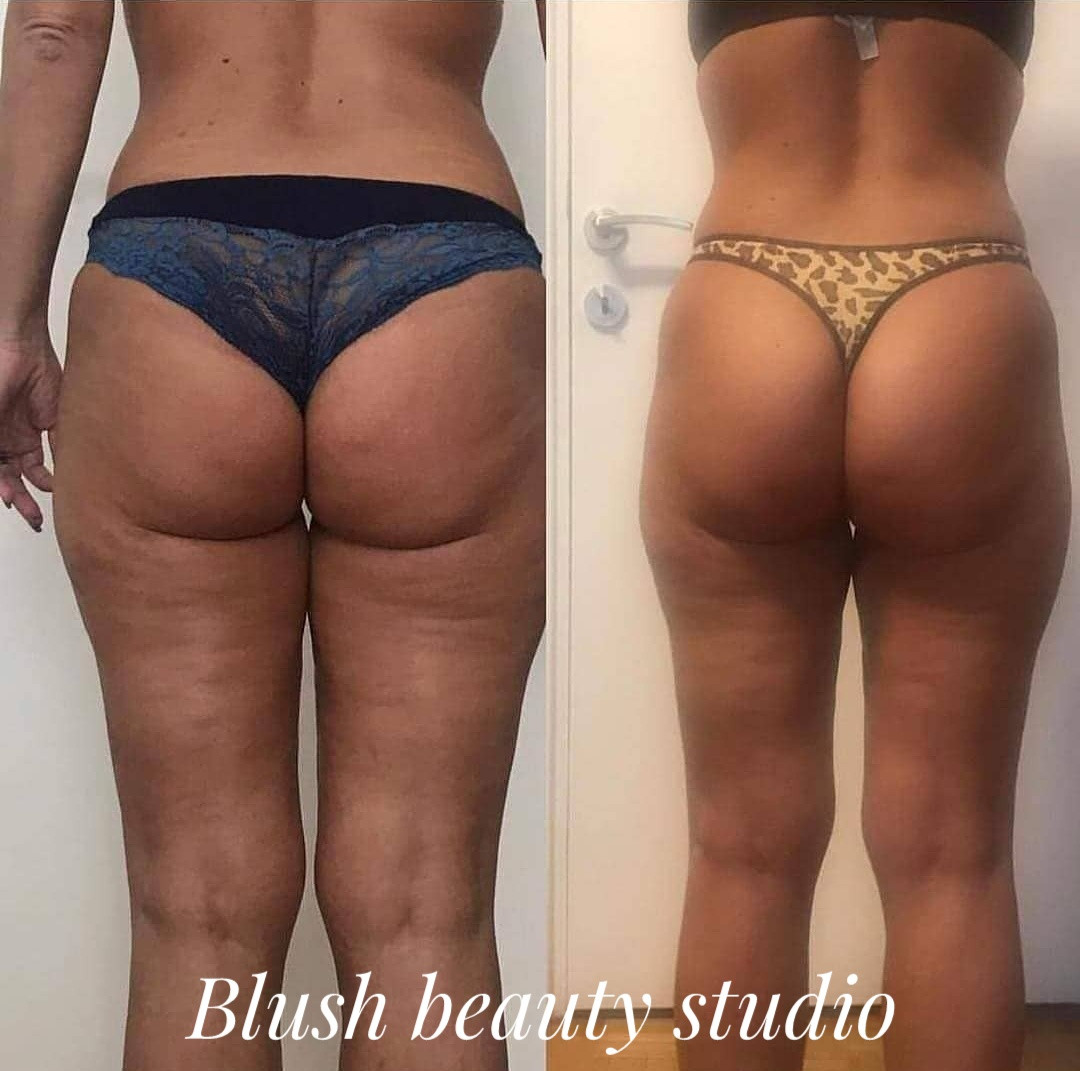 Blush Beauty Studio #beograd Anticelulit masaža Maderoterapija 45 minuta - paket od 10 tretmana