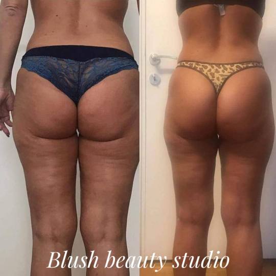 Blush Beauty Studio #beograd Anticelulit masaža Maderoterapija 45 minuta - paket od 10 tretmana