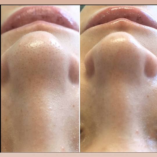 SkinLab Beauty Centar #novisad Tretman lica Higijenski tretman lica