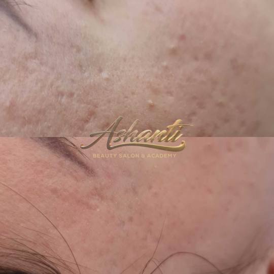 Ashanti Beauty Salon & Academy #beograd Dermaroler i dermapen Dermapen - celo lice