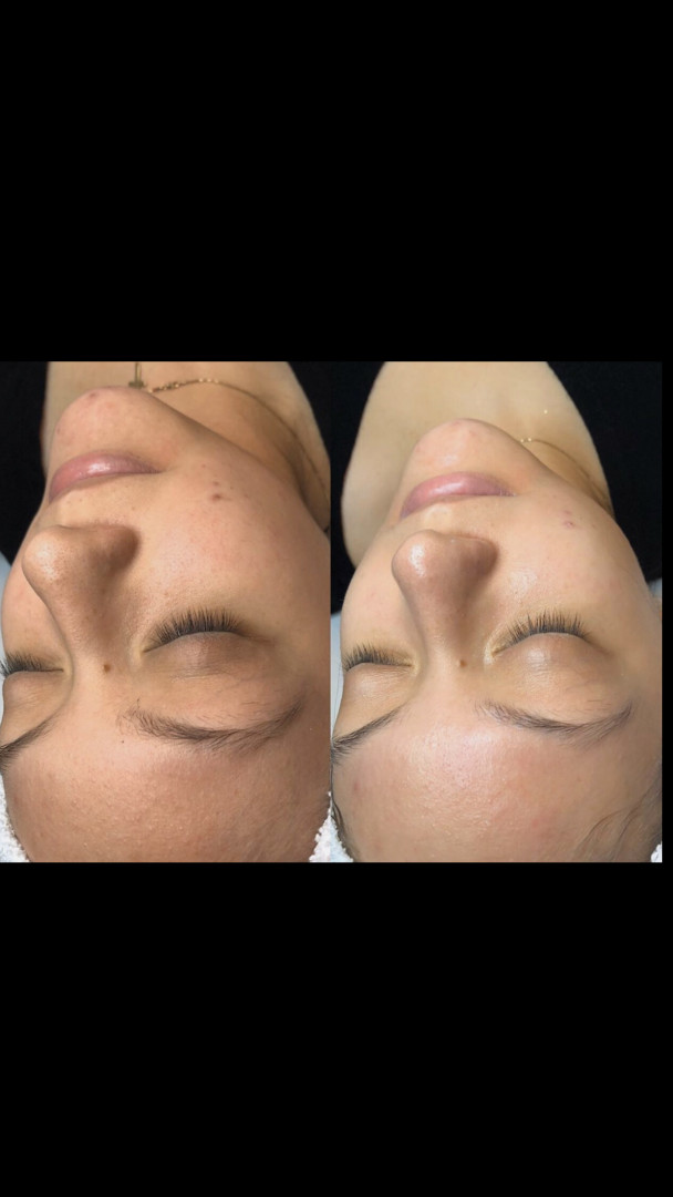 SkinLab Beauty Centar #novisad Tretman lica Dijamantska mikrodermoabrazija + ampula za hidrataciju