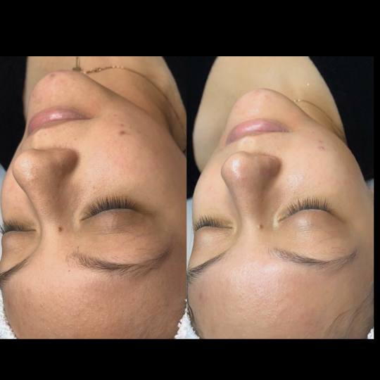 SkinLab Beauty Centar #novisad Tretman lica Dijamantska mikrodermoabrazija + ampula za hidrataciju
