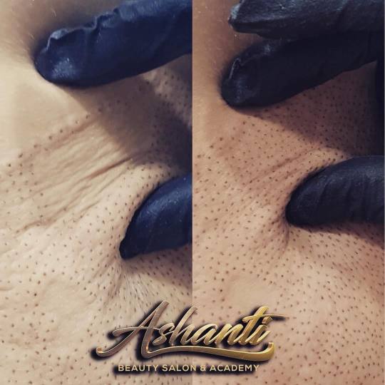Ashanti Beauty Salon & Academy #beograd Tretman lica Plasma pen - stomak
