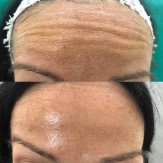 Ordinacija Stanojlović #krusevac Kozmetički doktori Botox - kompletan srednji deo lica