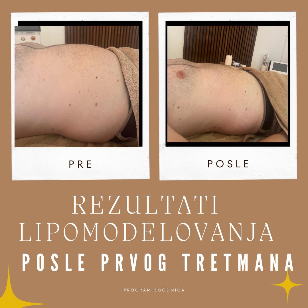 Brazilsko lipomodelovanje - stomak - Zgodnica, Beograd Anticelulit masaža Masaža Anticelulit masaža, Beograd, Jajinci