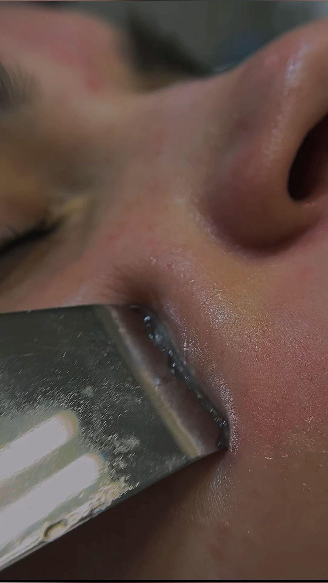 L’Avenue #beograd Tretman lica Higijenski tretman lica sa ultrazvučnim čišćenjem