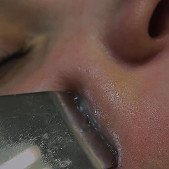 L’Avenue #beograd Tretman lica Higijenski tretman lica sa ultrazvučnim čišćenjem