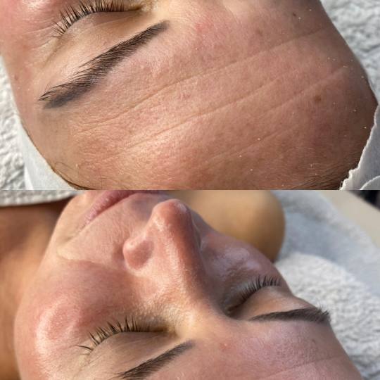 Beauty and nutrition #beograd Lifting / zatezanje kože Kolagen trake+kolagen niti+botox maska