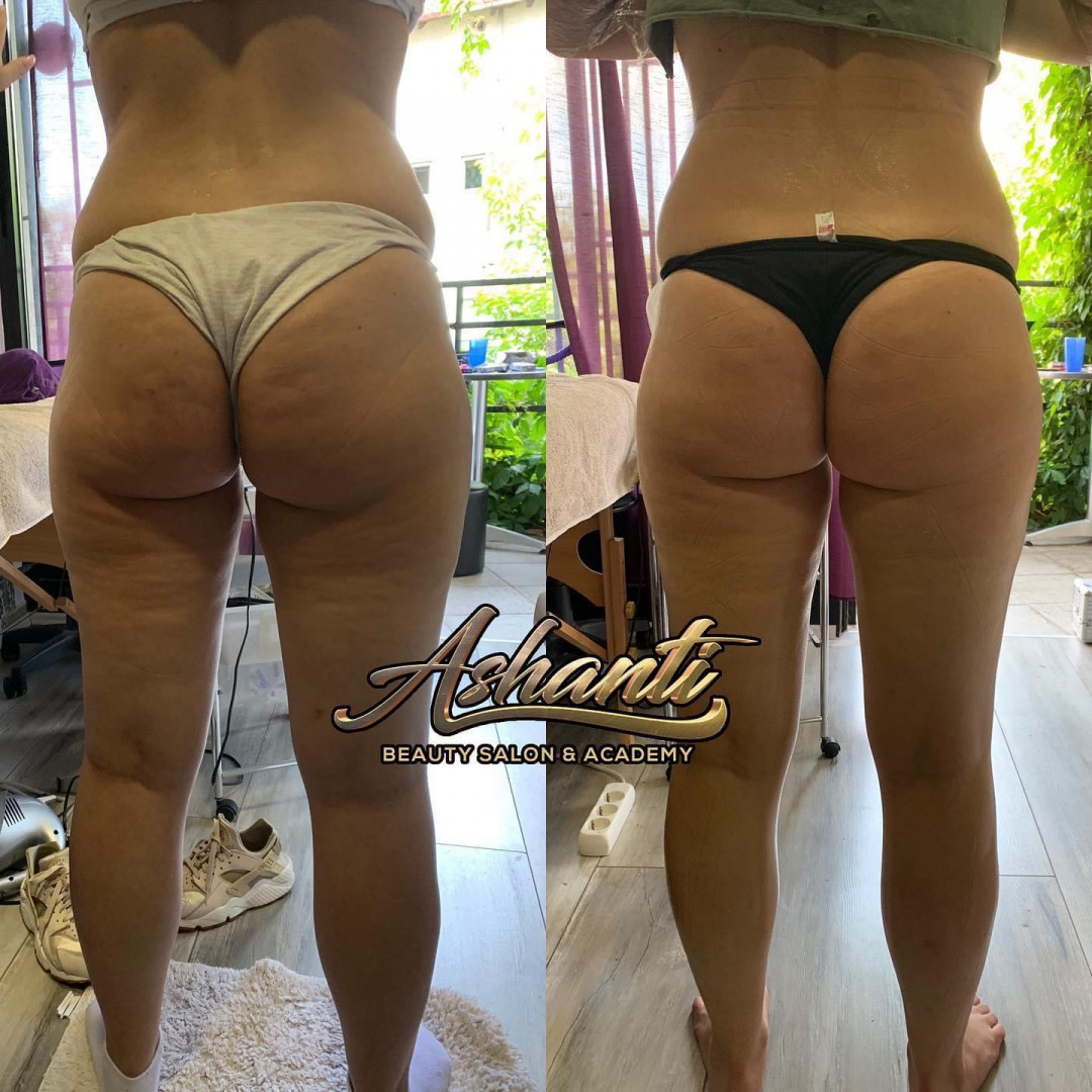 Ashanti Beauty Salon & Academy #beograd Masaža za mršavljenje Vacuslim 48 / Vacuumfit - stomak + bokovi + noge - paket od 5 tretmana