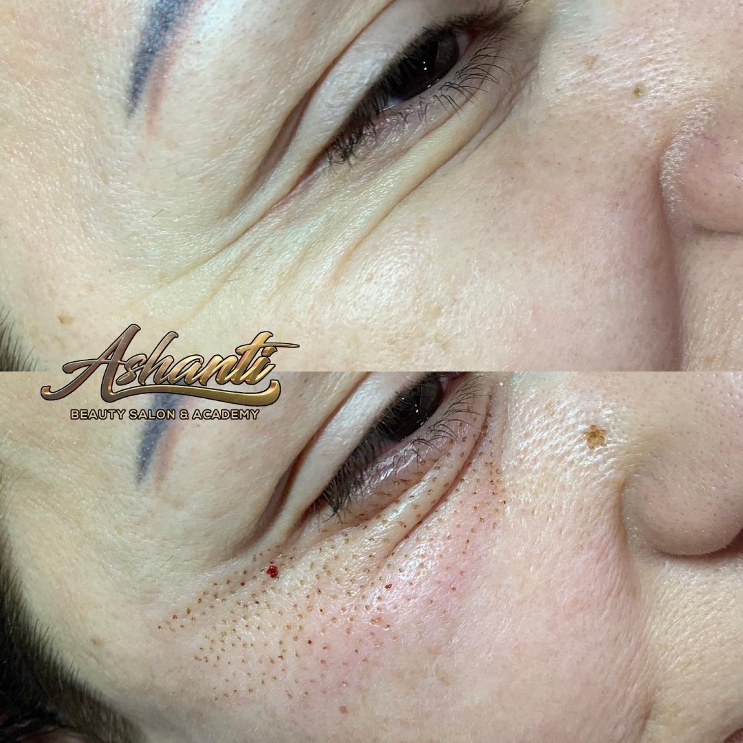 Plasma pen - podočnjaci - Ashanti Beauty Salon & Academy, Beograd Tretman lica Lice Tretman lica, Beograd, Voždovac