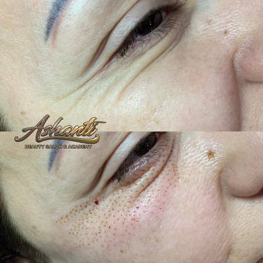 Ashanti Beauty Salon & Academy #beograd Tretman lica Plasma pen - podočnjaci