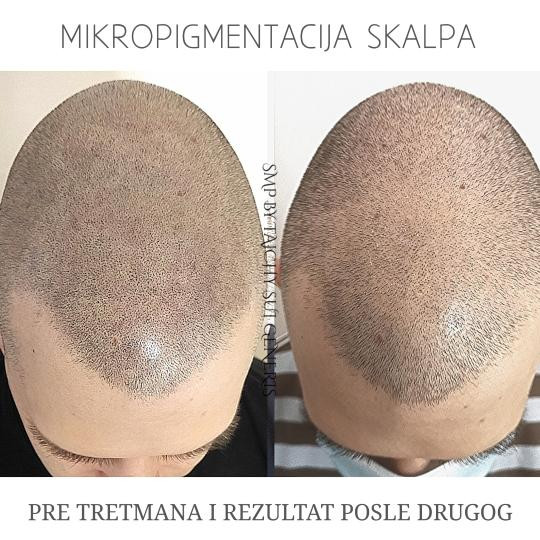 Mikropigmentacija skalpa - manje površine - Oui Oui, Beograd Mikropigmentacija skalpa Frizerski saloni Mikropigmentacija skalpa, Beograd, Zvezdara