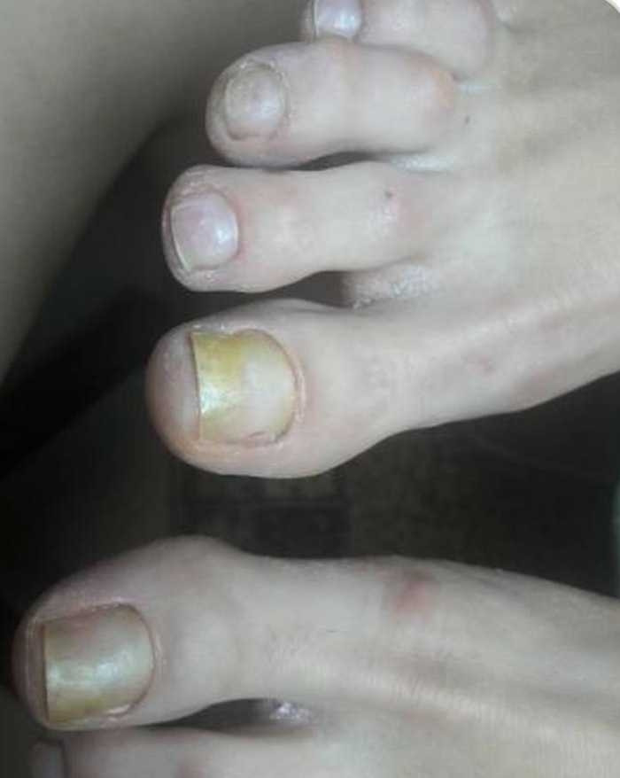 Tina B #beograd Medicinski pedikir Medicinski pedikir - gljivični / oboleli nokti