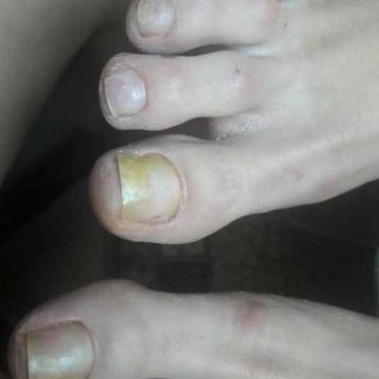 Tina B #beograd Medicinski pedikir Medicinski pedikir - gljivični / oboleli nokti