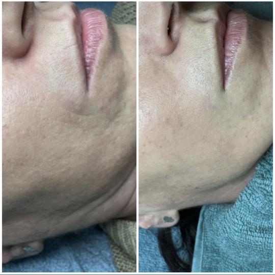 Petra beauty concept #beograd Dermaroler i dermapen Dermapen tretman lica