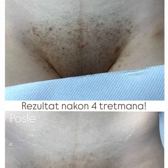 Maison de mi #beograd Laserska epilacija Brazilska laserska epilacija - paket od 4 tretmana