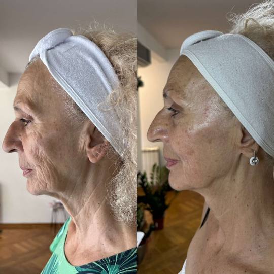 Iv Skin #beograd