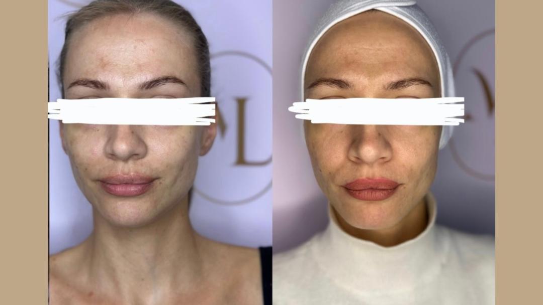 Attento Aesthetic #beograd Radiotalasni i ultrazvučni tretmani Hifu tretman - lice + vrat + dekolte