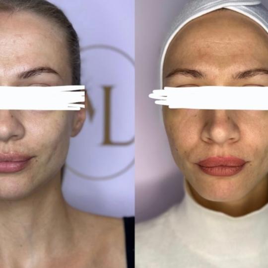 Attento Aesthetic #beograd Radiotalasni i ultrazvučni tretmani Hifu tretman - lice + vrat + dekolte