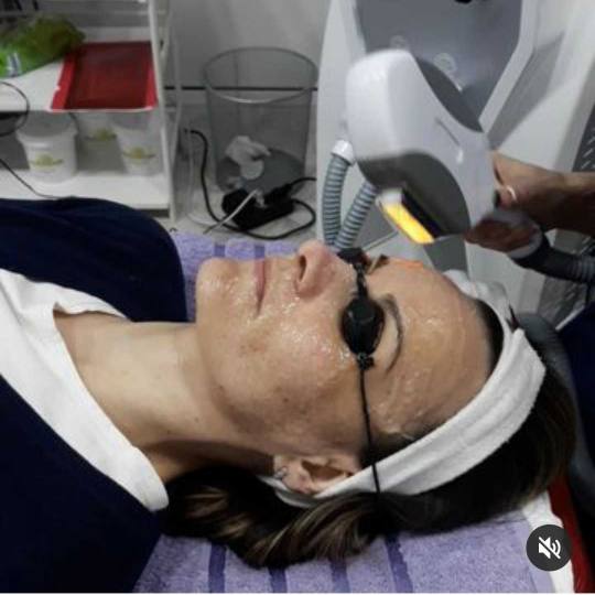 AltaBella Batajnica #beograd Laserski tretmani lica Lasersko podmlađivanje lica