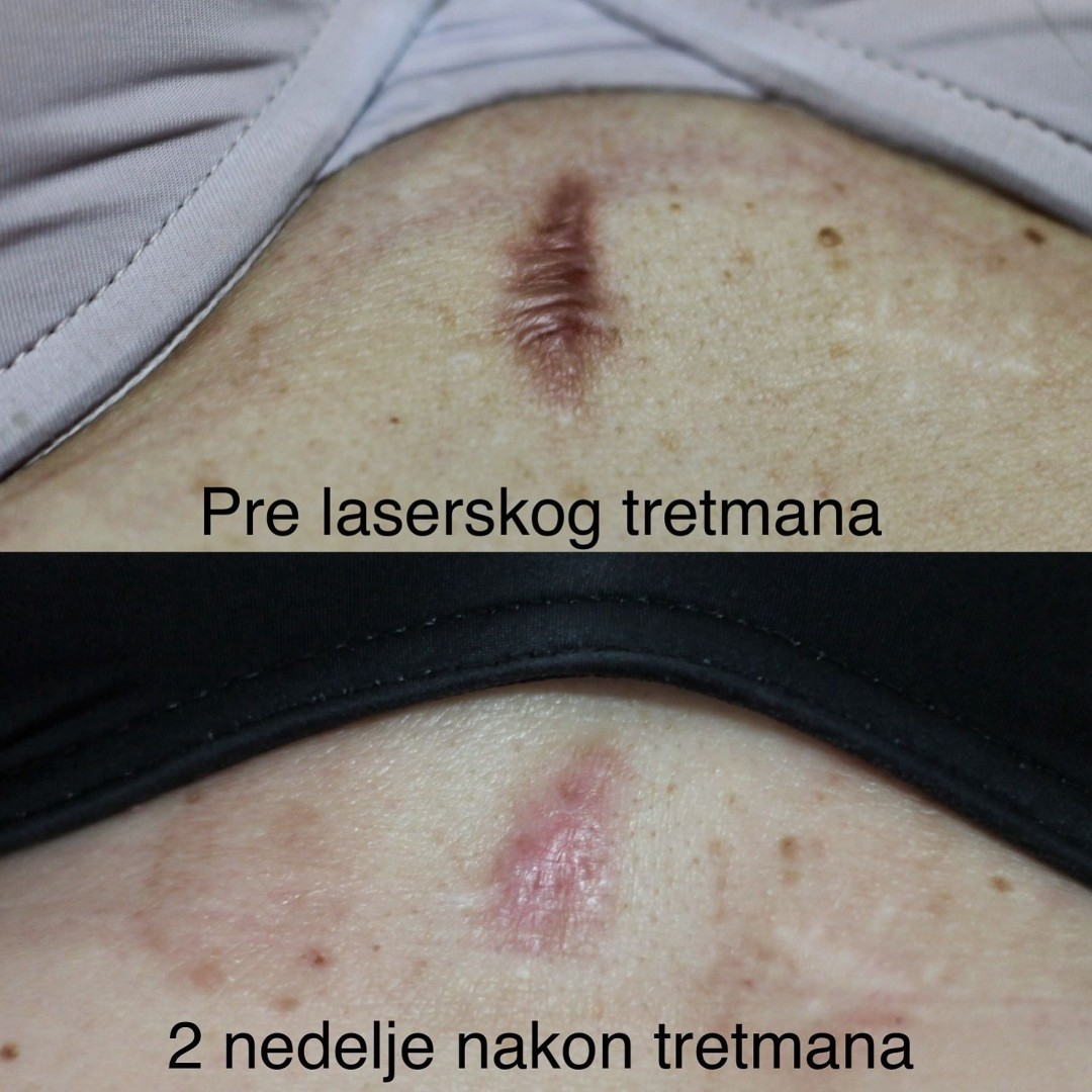 Poliklinika Marić #novisad Tretmani tela Lasersko uklanjanje ožiljaka