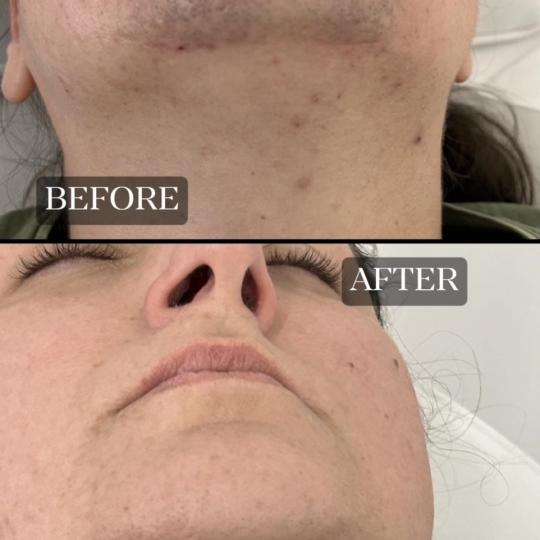 Lash & Light Studio #beograd Laserska epilacija Laserska epilacija podbratka - za dame Laserska epil