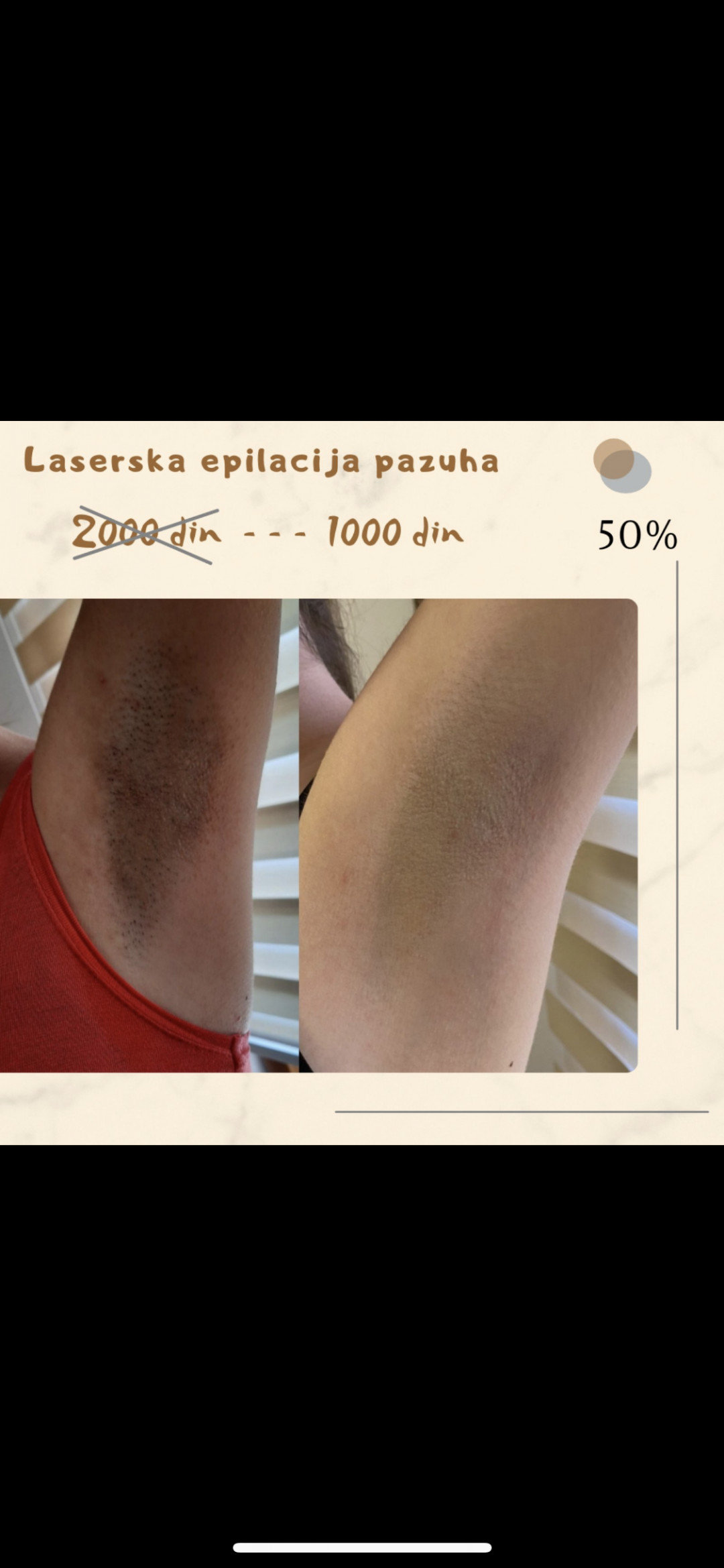 D&D Beauty Center #beograd Laserska epilacija Laserska epilacija pazuha - za dame