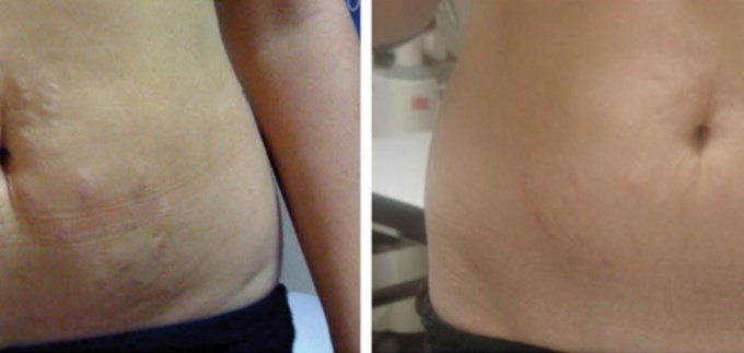 Vila Beauty Studio #beograd Tretman lica Plasma pen (po regiji)