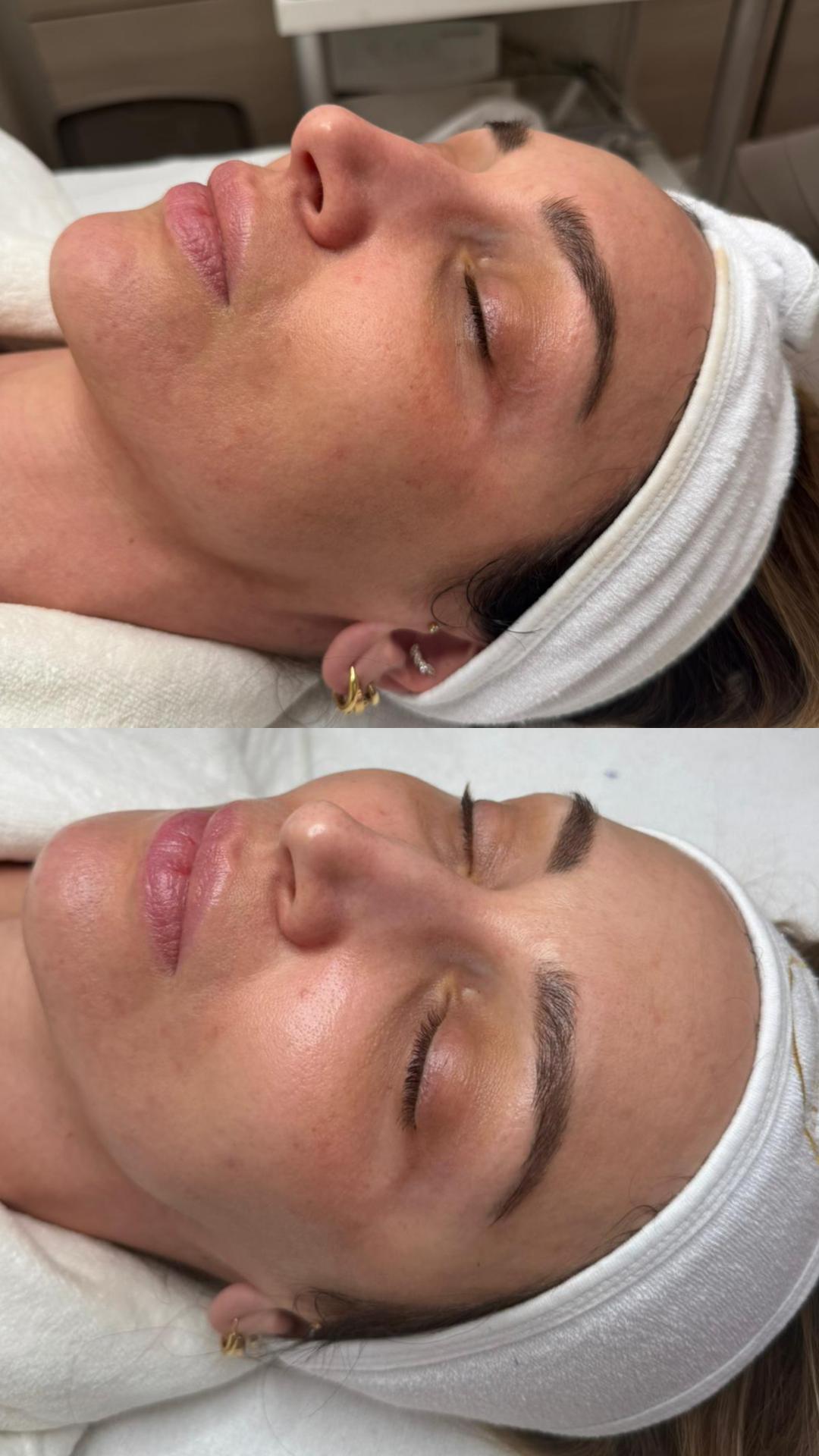 Choco Love #beograd Tretman lica Higijenski tretman lica + hemijski piling