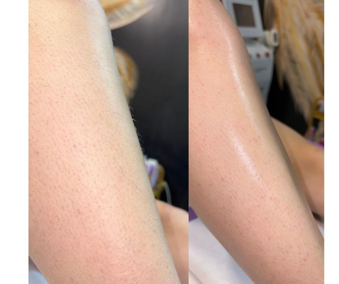 Angels #novisad Depilacija toplim voskom Depilacija celog tela