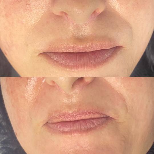 Beauty by Nevena Panić #beograd Tretman lica Winner filer tretman Osveženje usana prirodnim hijalu