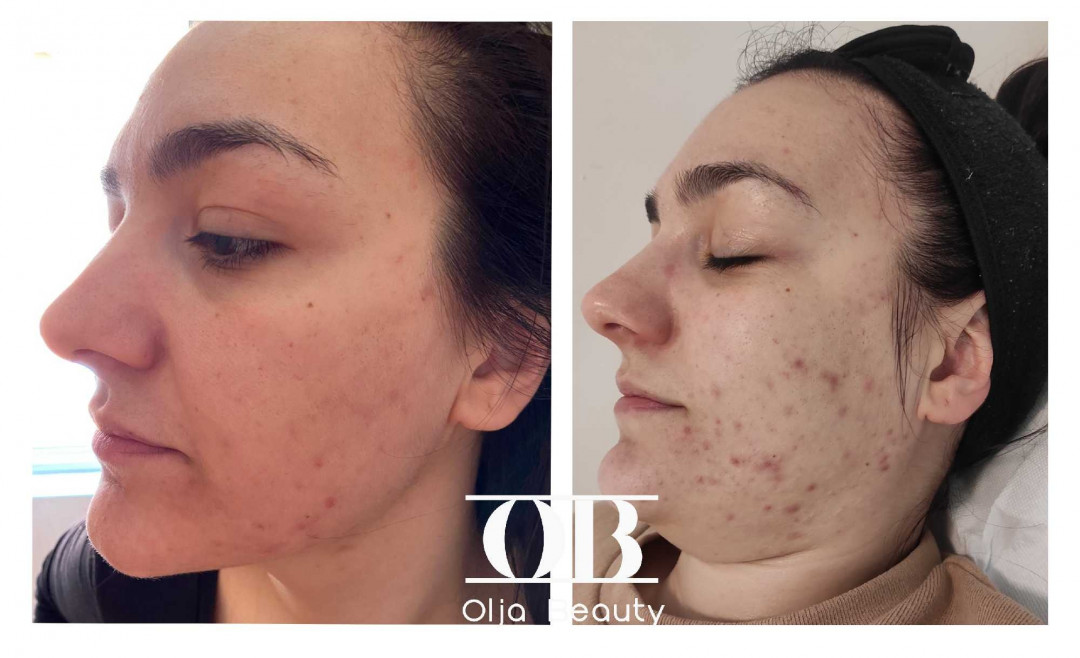 Olja Beauty #beograd Mezoterapija lica Mezoterapija + hemijski piling