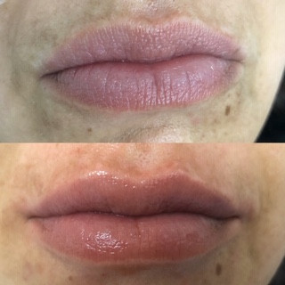 Ordinacija Stanojlović #krusevac Dermalni fileri Hijaluronski filer 0.5 ml - uvećavanje usana