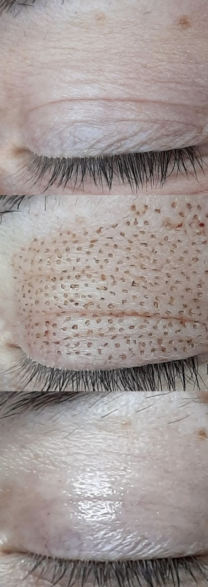 Plazmapen - kapci - Studio lepote i edukativni centar Helios, Kikinda Tretman lica Lice Tretman lica, Kikinda, Centar