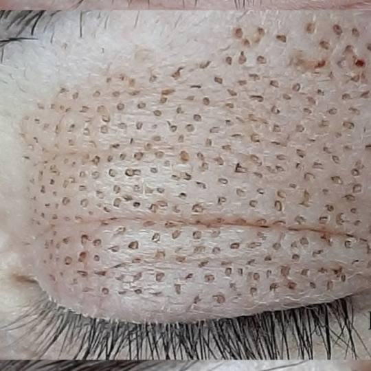 Studio lepote i edukativni centar Helios #kikinda Tretman lica Plazmapen - kapci Plazma penom resava