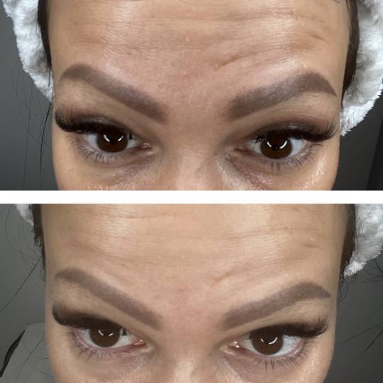 Beauty and nutrition #beograd Tretman lica Botox prah+dermapen+voćne kiseline+serumi za anti age+ma