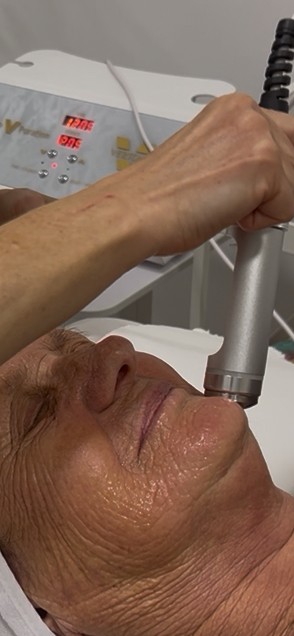 Mezoporacija lica - Sandra estetik studio, Beograd Tretman lica Lice Tretman lica, Beograd, Banovo brdo